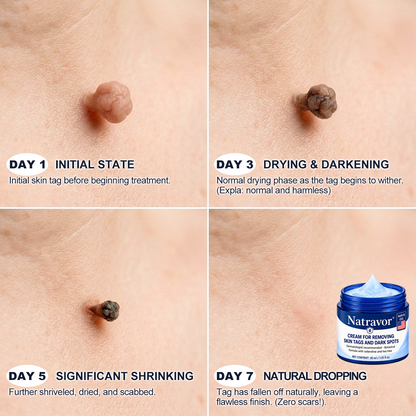 Natravor® 7-𝐃𝐚𝐲 𝐒𝐤𝐢𝐧 𝐓𝐚𝐠 & 𝐒𝐩𝐨𝐭 𝐄𝐫𝐚𝐬𝐞𝐫 𝐂𝐫𝐞𝐚𝐦 (Zero Pain, Zero 𝐒𝐜𝐚𝐫𝐬 Formula)