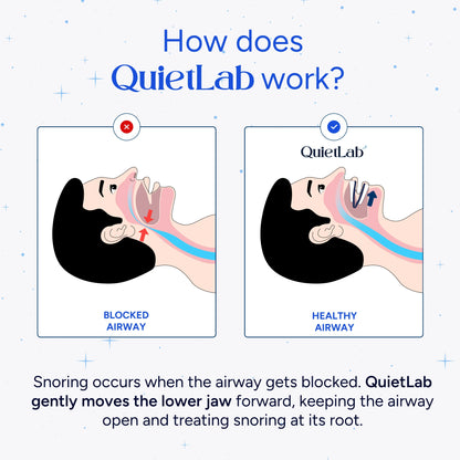 NATRAVOR® Adjustable Anti-Snoring Mouthpiece