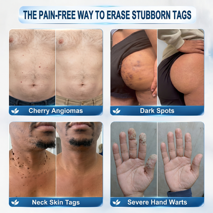 Natravor® 7-𝐃𝐚𝐲 𝐒𝐤𝐢𝐧 𝐓𝐚𝐠 & 𝐒𝐩𝐨𝐭 𝐄𝐫𝐚𝐬𝐞𝐫 𝐂𝐫𝐞𝐚𝐦 (Zero Pain, Zero 𝐒𝐜𝐚𝐫𝐬 Formula)