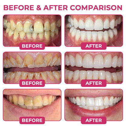 🇺🇸Natravor® DenPerm Cavity-Repair Natural Enamel Filling Gel