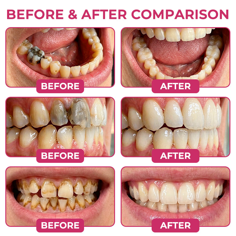 🇺🇸Natravor® DenPerm Cavity-Repair Natural Enamel Filling Gel